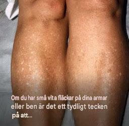 Varför får jag vita fläckar på huden på sommaren och hur kan jag behandla dem? En hudläkare svarar. 1