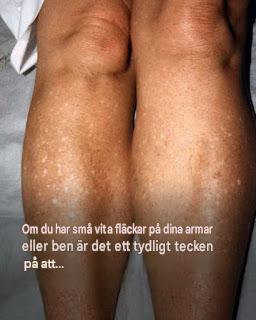 Varför får jag vita fläckar på huden på sommaren och hur kan jag behandla dem? En hudläkare svarar. 1