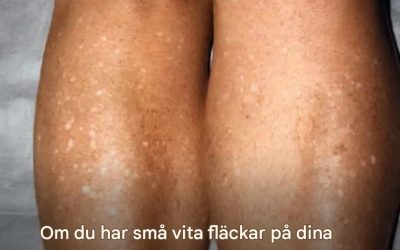 Om du har små vita fläckar på dina armar eller ben är det ett tydligt tecken på att…Se mer