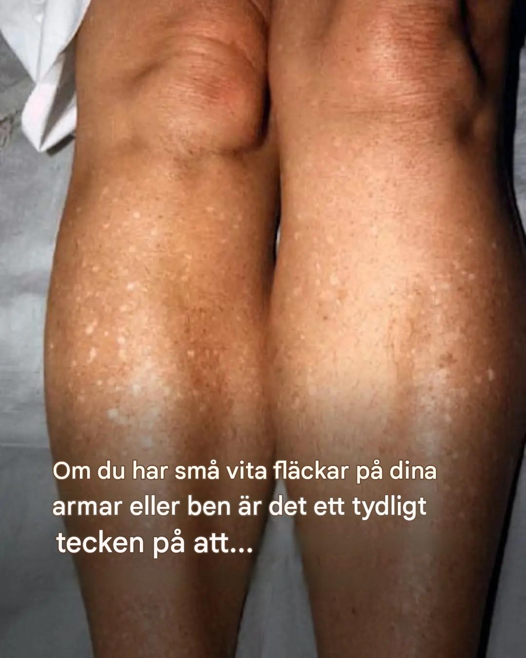 Om du har små vita fläckar på dina armar eller ben är det ett tydligt tecken på att…Se mer
