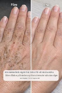 Min mamma lärde mig det här tricket för att minska mörka åldersfläckar på händerna på bara 3 minuter utan någon ansträngning. Så här fungerar det.